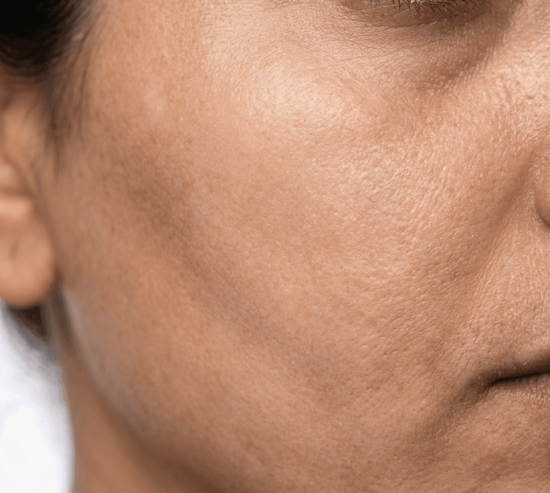 Dark Spot Reduction — after